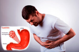 ¿Qué es la gastritis? Causas, diagnóstico y tratamiento