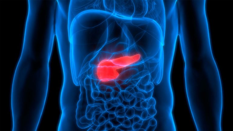 Qué es el cáncer páncreas y cuáles son sus síntomas