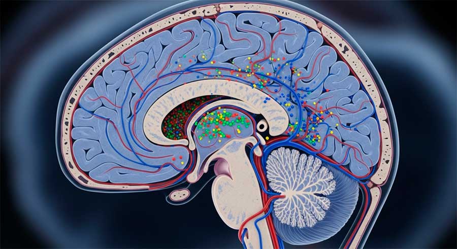 Microplásticos en el cerebro: un cerebro humano visto en corte, con vasos sanguíneos y muy pequeñas partículas de plástico de colores